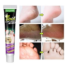 무좀 치료 발가려움 연고 항감염 무좀치료제 풋 케어 연고, 1개, 1개