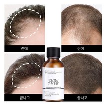 SKIN EVER 원형탈모 헤어트린트먼트 스칼프 기능성 두피영양 토닉 남성 여성, 30ml