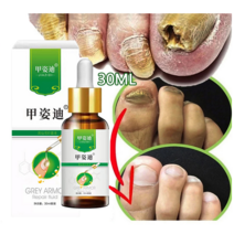 BT 발톱무좀 치료제 무좀약 무좀 케어제 발톱연화 무좀 관리, 2개, 30ml, 30ml